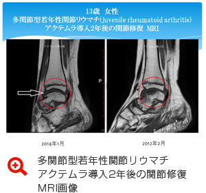 多関節型若年性関節リウマチ(juvenile rheumatoid arthritis)アクテムラ導入2年後の関節修復　MRI画像