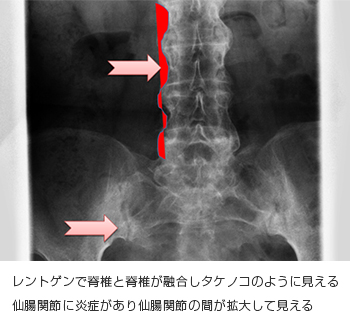 レントゲンで脊椎と脊椎が融合しタケノコのように見える　仙腸関節に炎症があり仙腸関節の間が拡大してみえる